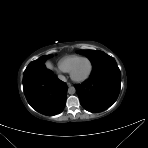 Centrilobular pulmonary emphysema (Radiopaedia 24495-24789 Axial non-contrast 36).jpg