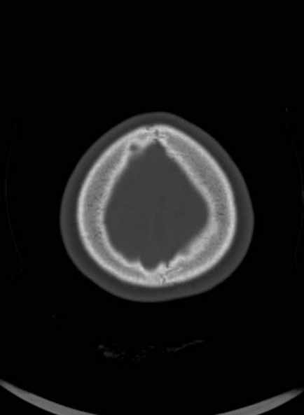 Cerebellar abscess (Radiopaedia 73727-84527 Axial bone window 60).jpg