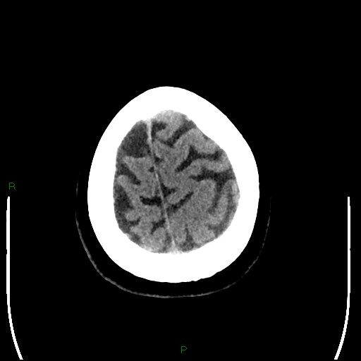 Cerebellar abscess (Radiopaedia 78135-90671 Axial non-contrast 99).jpg