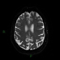 Cerebellar abscess (Radiopaedia 78135-90678 Axial DWI 51).jpg