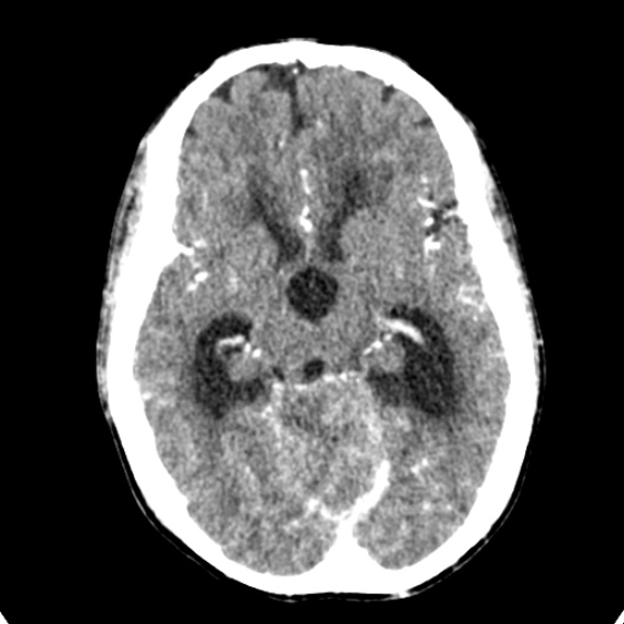 Cerebellar abscess secondary to mastoiditis (Radiopaedia 26284-26412 Axial C+ delayed 64).jpg