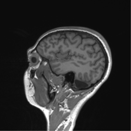 Cerebellar agenesis with hypoplastic pons (pontocerebellar hypoplasia) (Radiopaedia 57224-64138 Sagittal T1 20).png