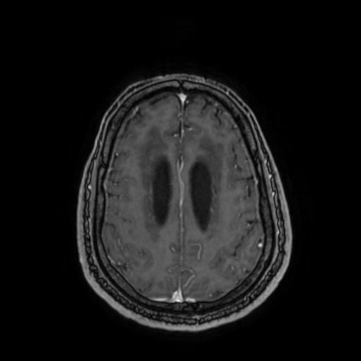 Cerebellar hemangioblastoma (Radiopaedia 88055-104622 Axial T1 C+ 131).jpg