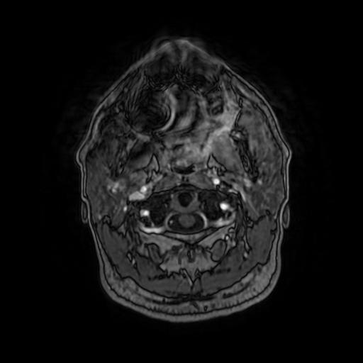 Cerebellar hemangioblastoma (Radiopaedia 88055-104622 Axial T1 C+ 16).jpg