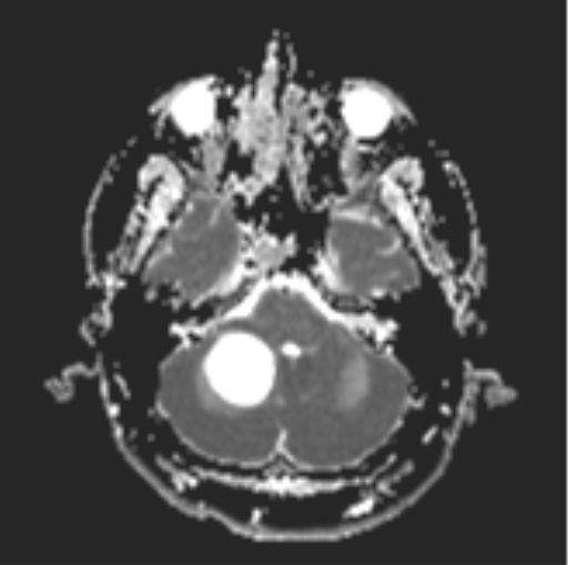 File:Cerebellar hemangioblastomas and pituitary adenoma (Radiopaedia 85490-101176 Axial ADC 8).png