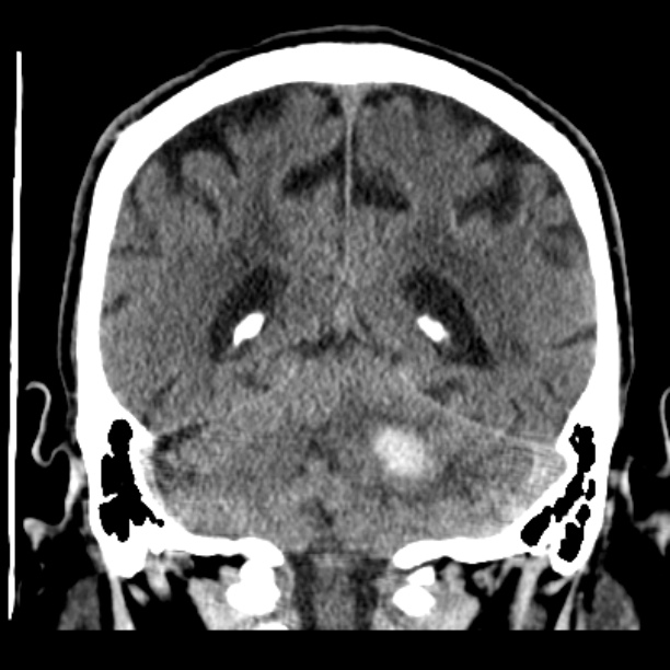 Cerebellar hemorrhage (Radiopaedia 27193-27359 Coronal non-contrast 40).jpg