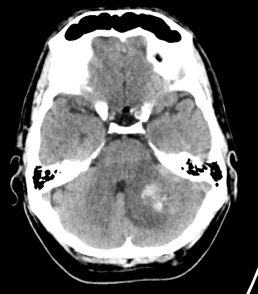 File:Cerebellar hemorrhage (Radiopaedia 37000-38669 Axial non-contrast 13).png