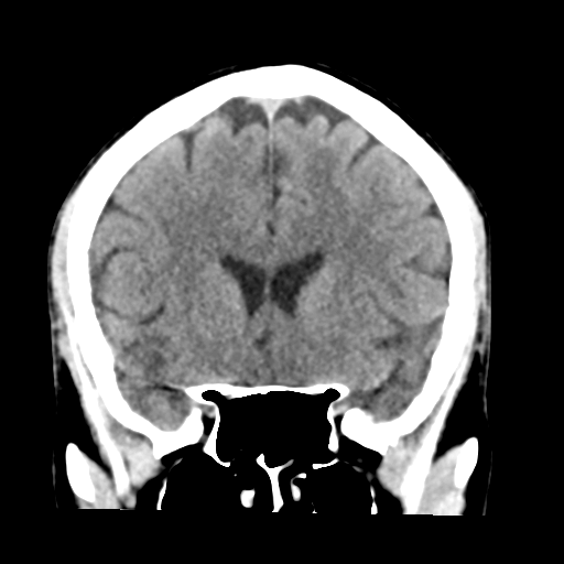 File:Cerebellar hemorrhage (Radiopaedia 37000-38669 Coronal non-contrast 17).png
