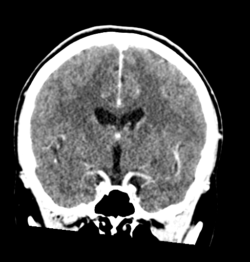 Cerebellar metastases - colorectal adenocarcinoma (Radiopaedia 40947-43652 Coronal C+ 43).png