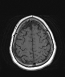 File:Cerebellar metastasis (Radiopaedia 54578-60810 Axial T1 32).png