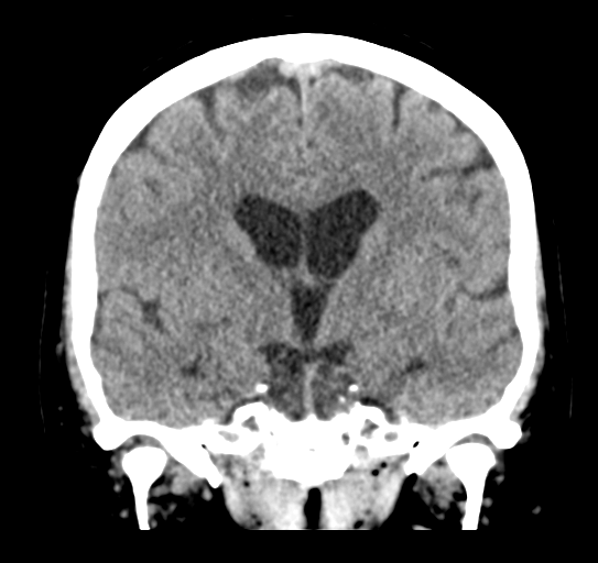 Cerebellar metastasis (Radiopaedia 54578-60812 Coronal non-contrast 27).png