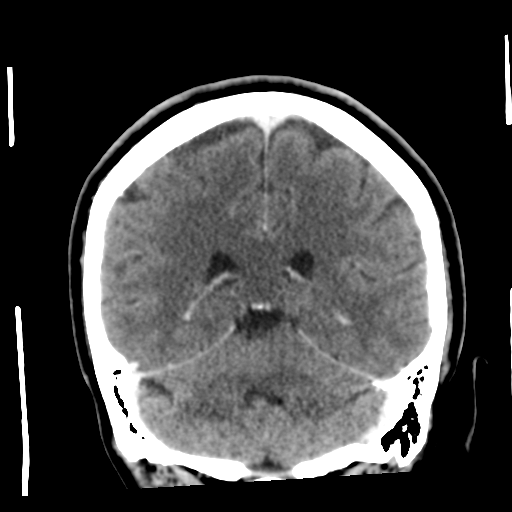 Cerebellar metastasis (cystic appearance) (Radiopaedia 41395-44258 D 41).png