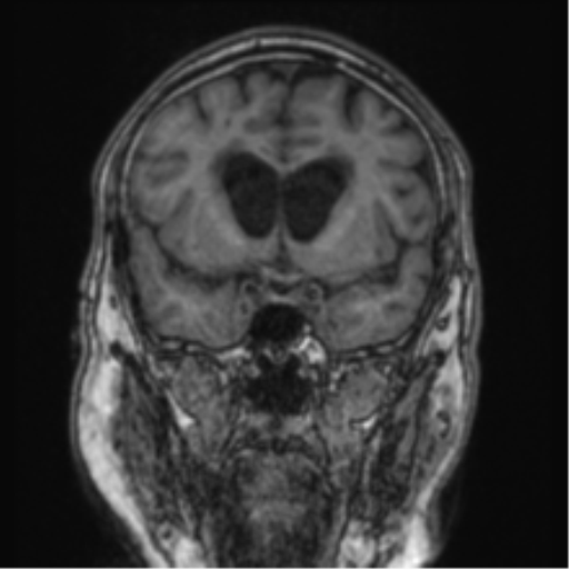 Cerebellar metastasis from lung adenocarcinoma (Radiopaedia 86690-102829 Coronal T1 64).png