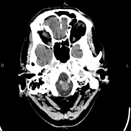 Cerebellopontine angle arachnoid cyst (Radiopaedia 85149-100704 Axial With contrast 4).jpg