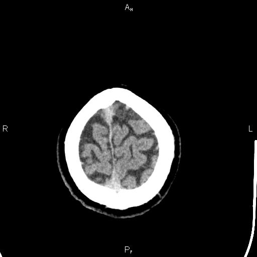 Cerebellopontine angle arachnoid cyst (Radiopaedia 85149-100704 Axial With contrast 49).jpg