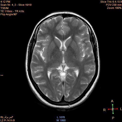 File:Cerebellopontine angle meningioma (Radiopaedia 22488-22525 Axial T2 8).jpg