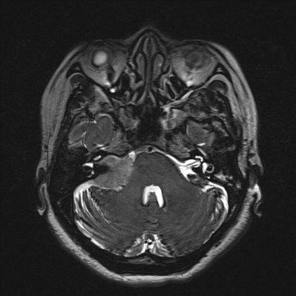 Cerebellopontine angle meningioma (Radiopaedia 53561-59591 Axial 3D volume T2 59).jpg