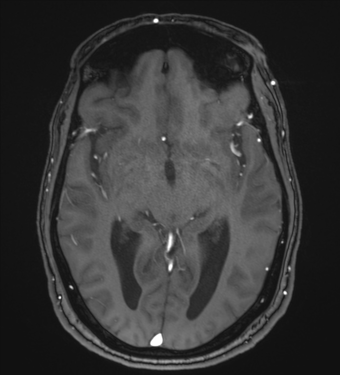 Cerebellopontine angle meningioma (Radiopaedia 72983-83680 Axial MRA 58).jpg