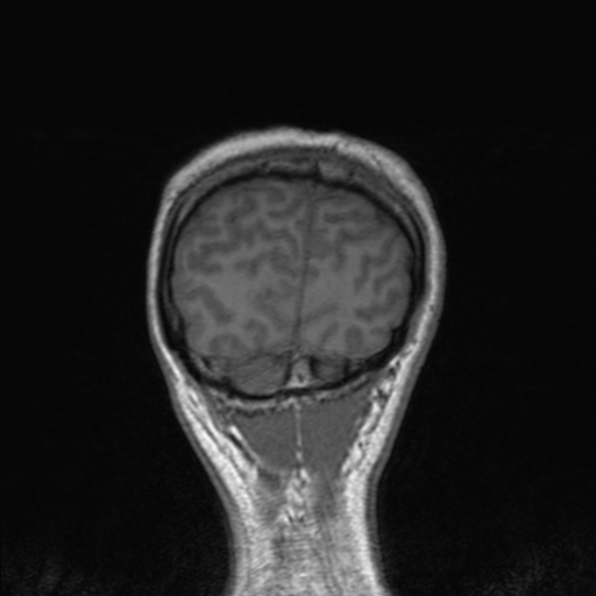 Cerebral abscess (Radiopaedia 24212-24478 Coronal T1 176).jpg