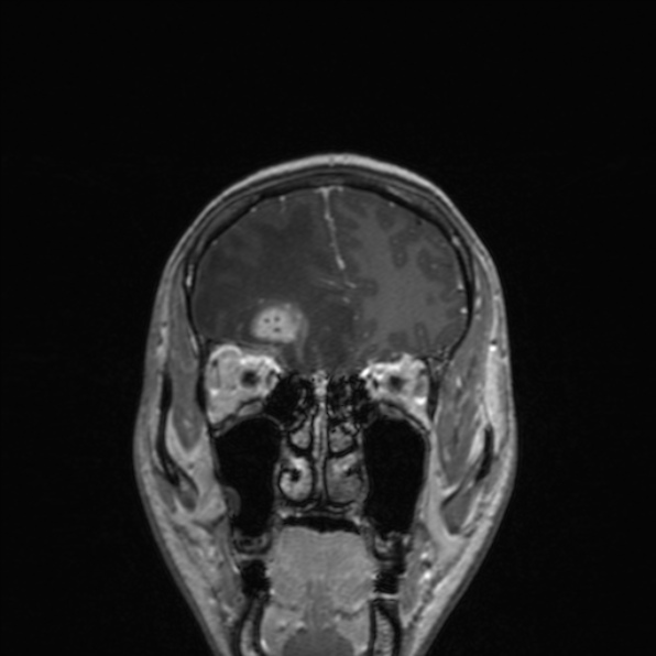 Cerebral abscess (Radiopaedia 24212-24478 Coronal T1 C+ 58).jpg