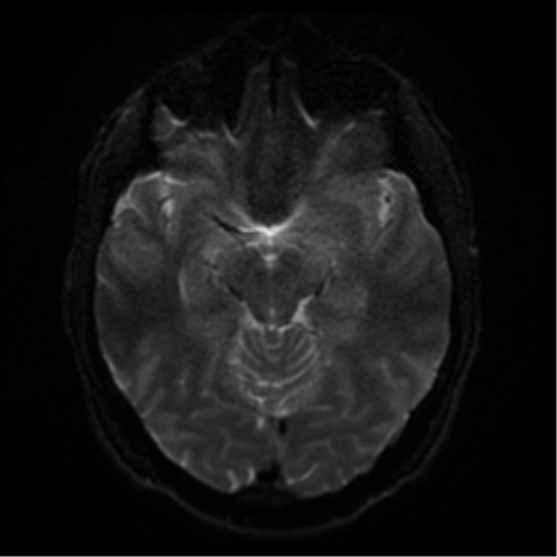 Cerebral abscess (Radiopaedia 57774-64740 Axial DWI 40).png