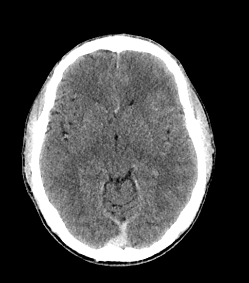 Cerebral abscess (Radiopaedia 57774-64741 Axial C+ delayed 33).png