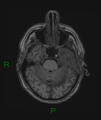 Cerebral abscess and subdural empyema (Radiopaedia 84436-99779 Axial T1 60).jpg