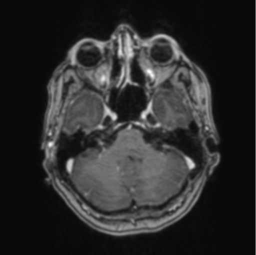 Cerebral abscess from pulmonary arteriovenous malformation (Radiopaedia 86275-102291 Axial T1 C+ 21).png