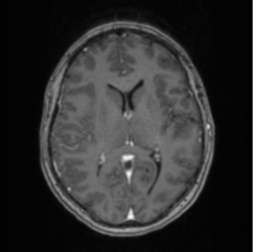 Cerebral abscess from pulmonary arteriovenous malformation (Radiopaedia 86275-102291 Axial T1 C+ 41).png