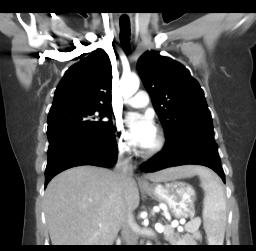 Cerebral abscess from pulmonary arteriovenous malformation (Radiopaedia 86275-102292 C 26).png