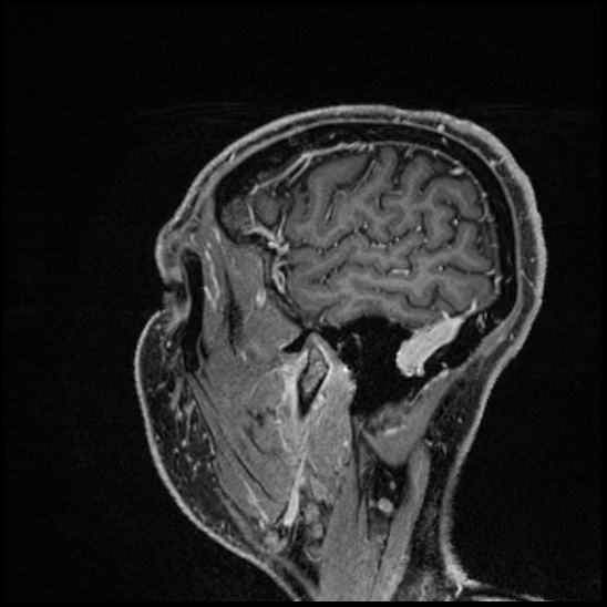 Cerebral abscess with ventriculitis (Radiopaedia 78965-91878 Sagittal T1 C+ 152).jpg