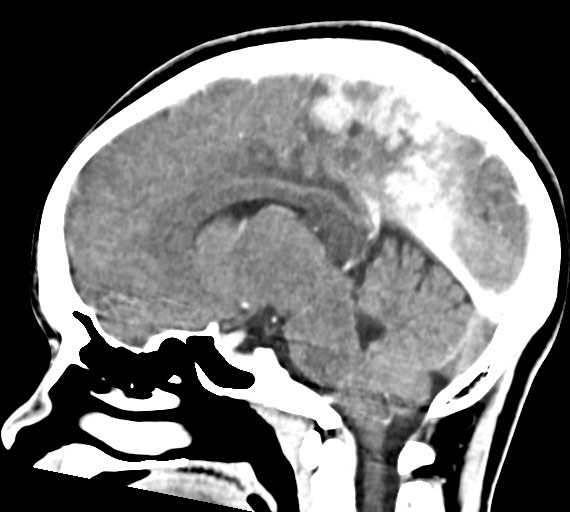 Cerebral abscesses (Radiopaedia 70458-80568 Sagittal Contrast 28).jpg