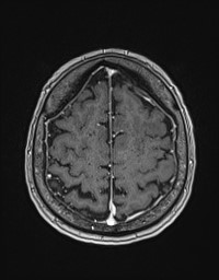 Cerebral amyloid angiopathy-related inflammation (Radiopaedia 58270-65377 Axial T1 C+ fat sat 117).jpg