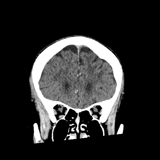 Cerebral amyloid angiopathy-related inflammation (Radiopaedia 74836-85848 Coronal non-contrast 21).jpg