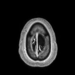 Cerebral amyloid angiopathy (Radiopaedia 29129-29518 Axial T1 C+ 142).jpg