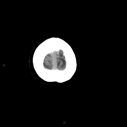 Cerebral amyloid angiopathy (Radiopaedia 77506-89665 Axial non-contrast 107).jpg