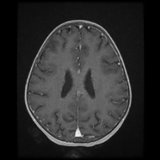 File:Cerebral and spinal tuberculosis (Radiopaedia 90489-107837 Axial T1 C+ 129).jpg