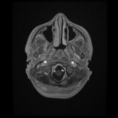 Cerebral and spinal tuberculosis (Radiopaedia 90489-107837 Axial T1 C+ 35).jpg