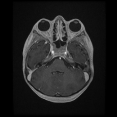 Cerebral and spinal tuberculosis (Radiopaedia 90489-107837 Axial T1 C+ 61).jpg