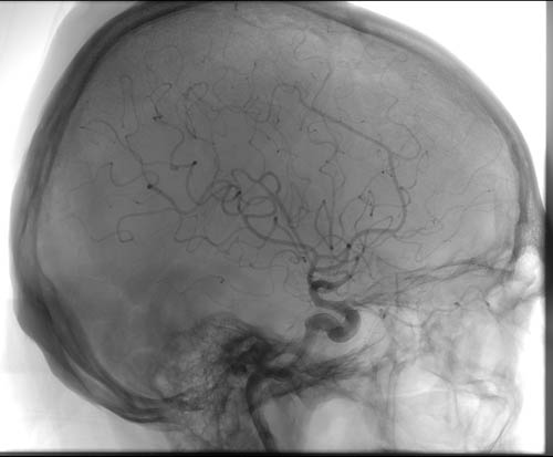 File:Cerebral angiographic projections (Radiopaedia 46308-50712 E 1).jpg