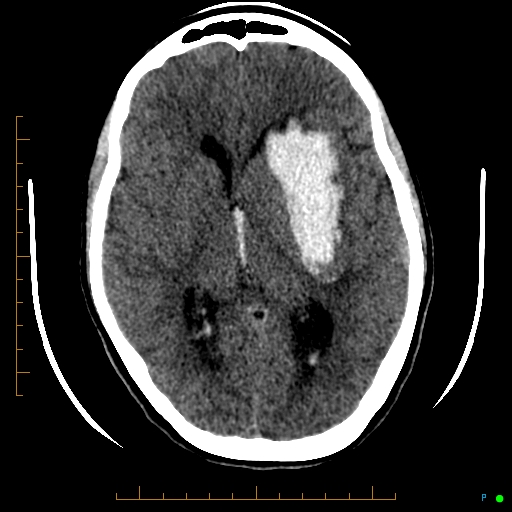 Cerebral arteriovenous malformation (AVM) (Radiopaedia 78162-90706 Axial non-contrast 33).jpg