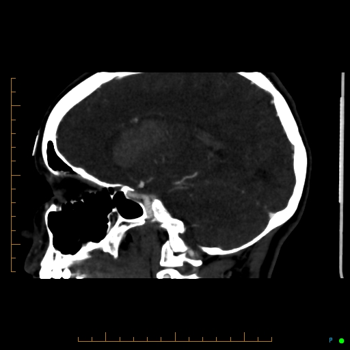 Cerebral arteriovenous malformation (AVM) (Radiopaedia 78162-90706 Sagittal CTA 34).jpg