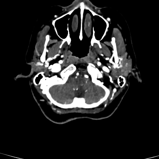 Cerebral arteriovenous malformation (Radiopaedia 73830-84645 Axial C+ delayed 86).jpg