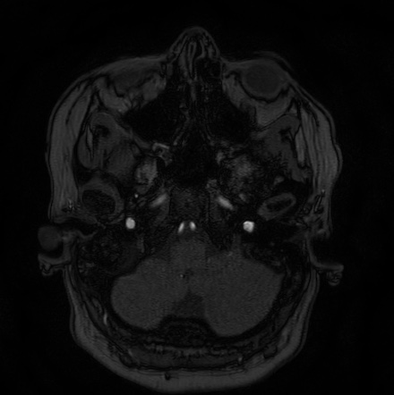 Cerebral arteriovenous malformation (Radiopaedia 74411-85654 Axial MRA 6).jpg