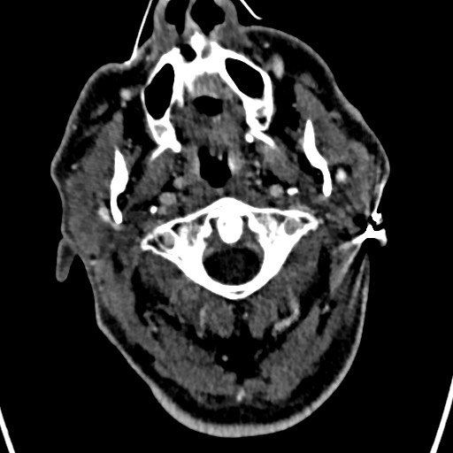 Cerebral arteriovenous malformation (Radiopaedia 78188-90746 Axial C+ delayed 1).jpg