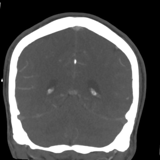 Cerebral arteriovenous malformation (Spetzler-Martin grade 2) (Radiopaedia 41262-44076 F 47).png