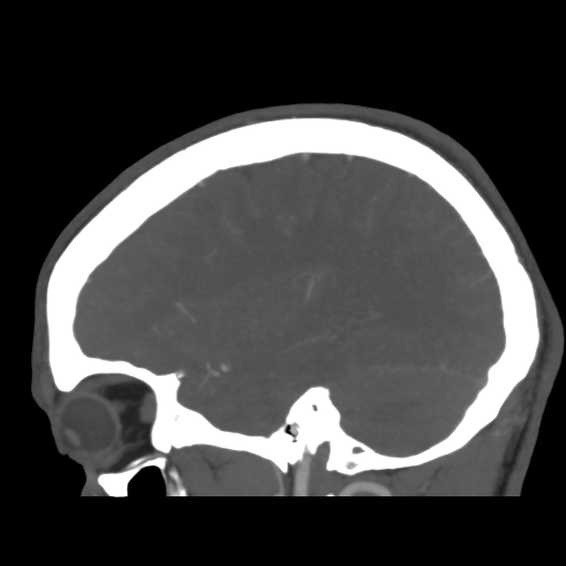 Cerebral arteriovenous malformation (Spetzler-Martin grade 2) (Radiopaedia 41262-44076 G 39).png