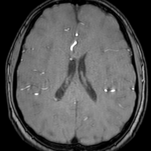 Cerebral arteriovenous malformation at posterior body of corpus callosum (Radiopaedia 74111-84925 Axial MRA 134).jpg