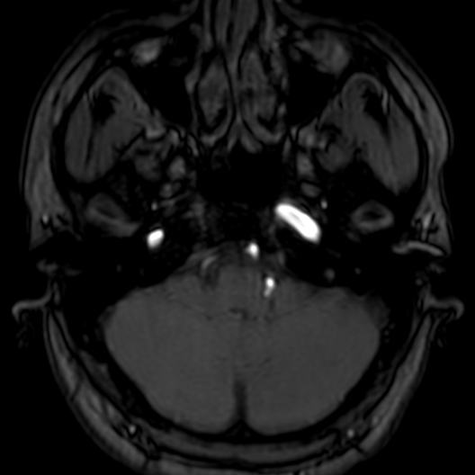 Cerebral arteriovenous malformation at posterior body of corpus callosum (Radiopaedia 74111-84925 Axial MRA 30).jpg