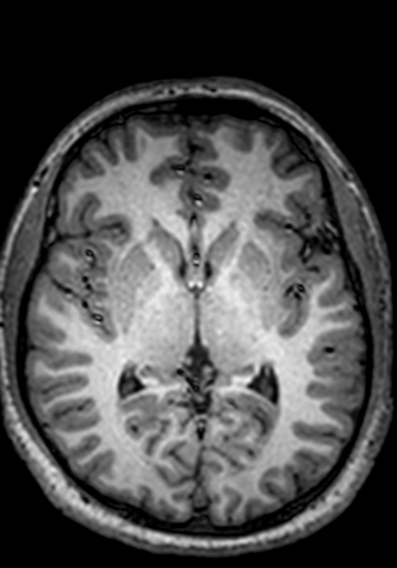 Cerebral arteriovenous malformation at posterior body of corpus callosum (Radiopaedia 74111-84925 Axial T1 146).jpg